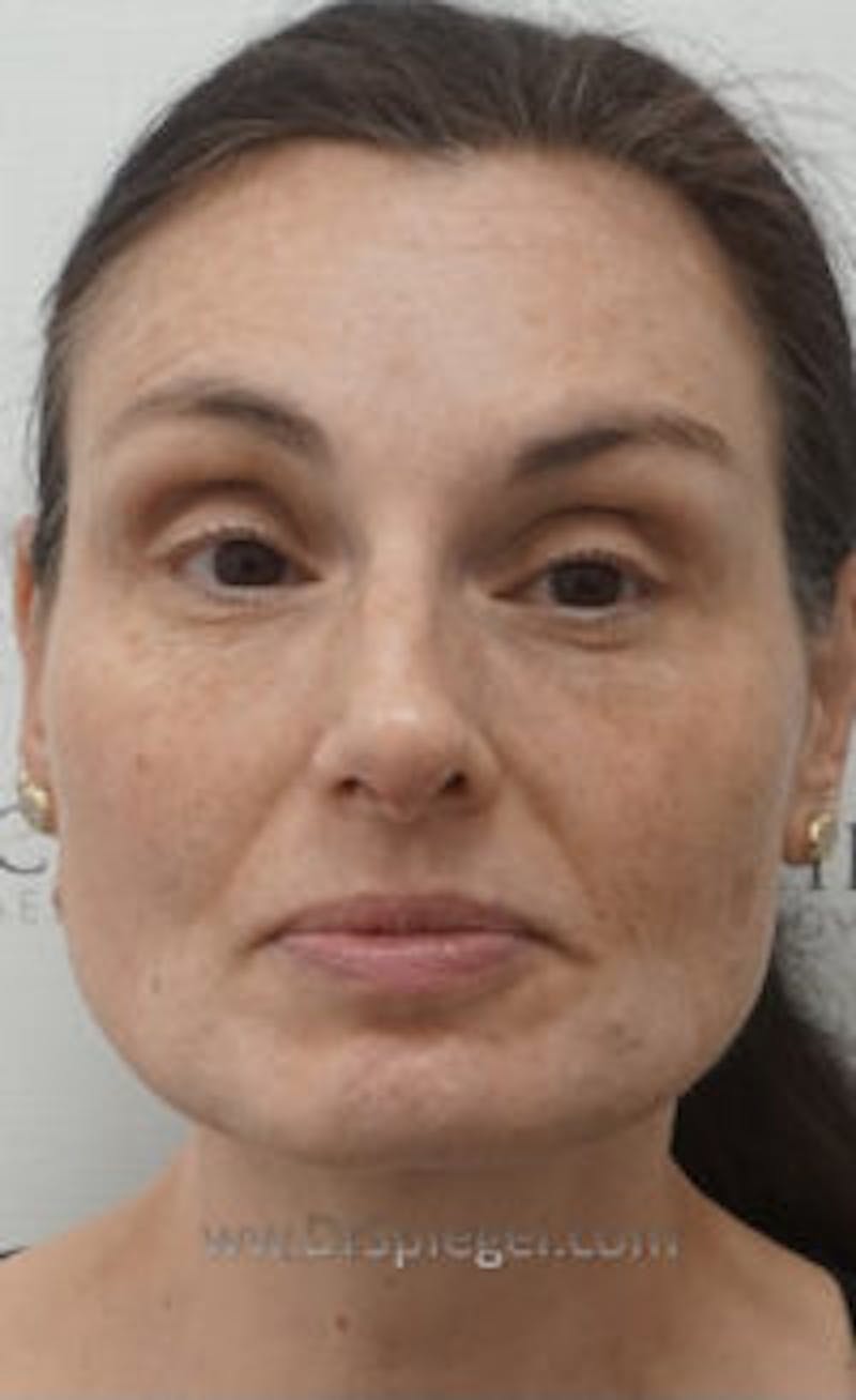Botox / Dysport / Jeuveau / Xeomin Before & After Gallery - Patient 157140420 - Image 3