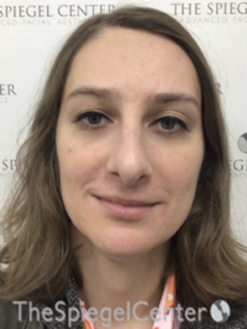 FFS Before & After Gallery - Patient 157140426 - Image 2