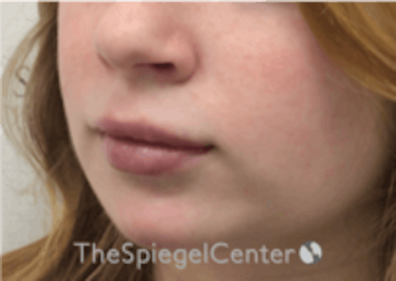 Lip Filler Before & After Gallery - Patient 157140419 - Image 6