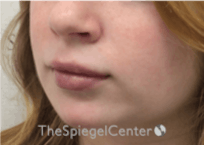 Lip Filler Before & After Gallery - Patient 157140419 - Image 6