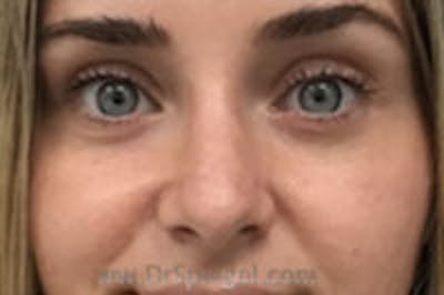 Rhinoplasty Before & After Gallery - Patient 157140422 - Image 4