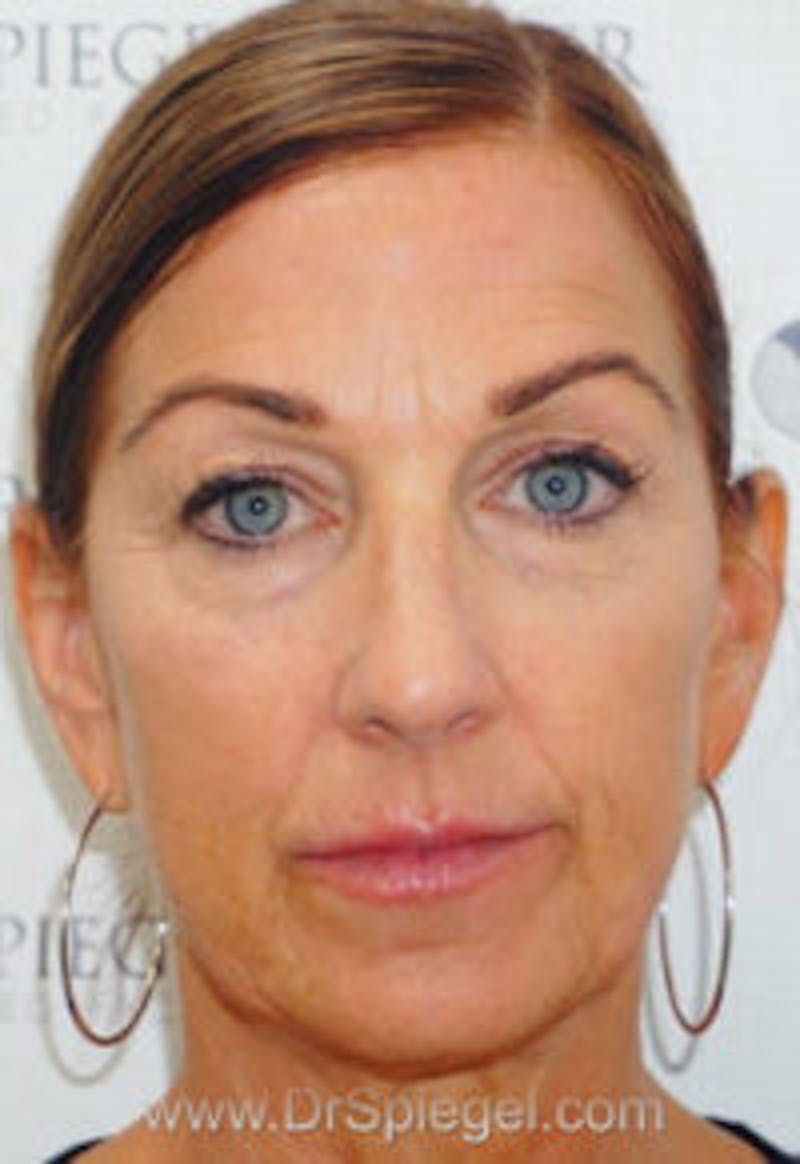 Liquid Face Lift Before & After Gallery - Patient 183935114 - Image 1