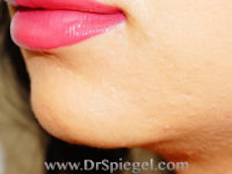 Chin Filler Before & After Gallery - Patient 157140425 - Image 2