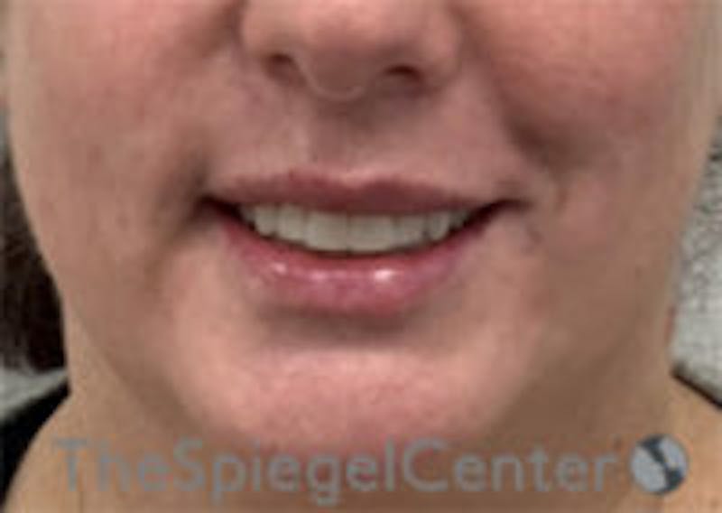 Lip Filler Before & After Gallery - Patient 157140435 - Image 2