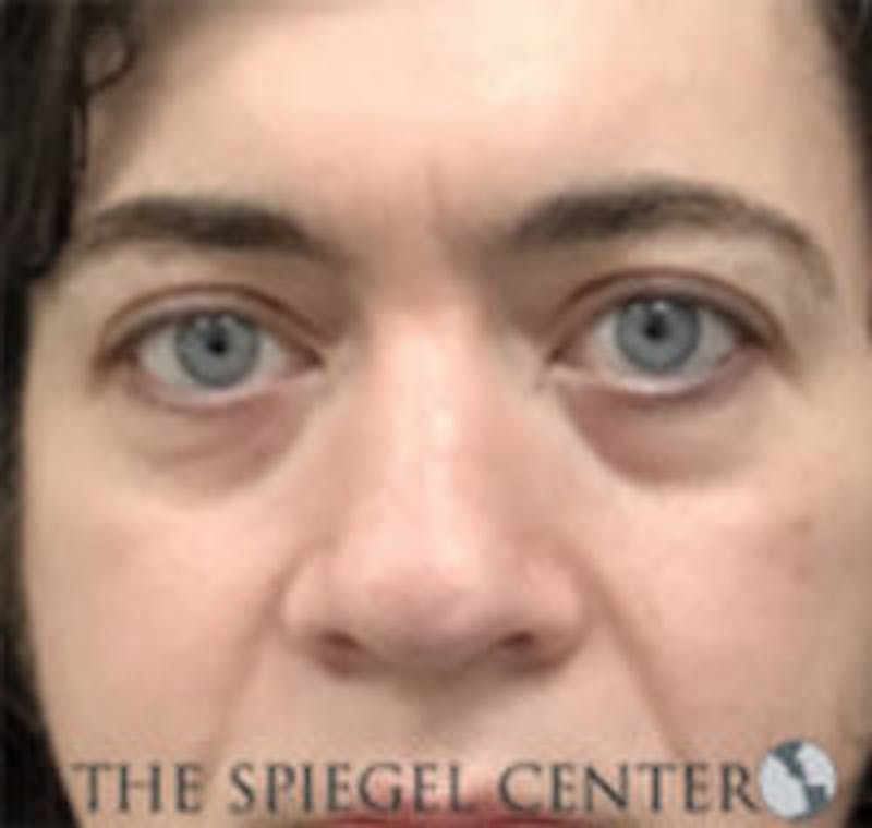 Rhinoplasty Before & After Gallery - Patient 157140434 - Image 3