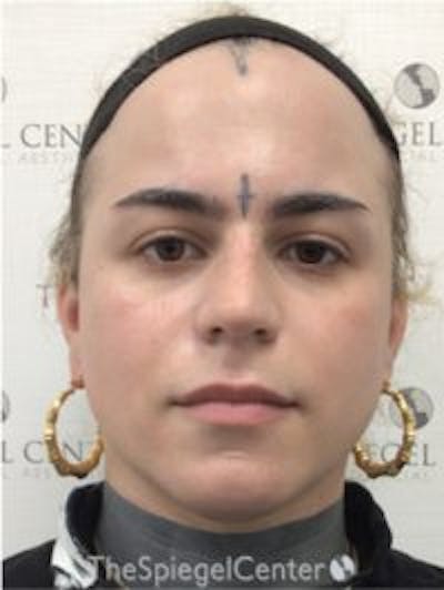 FFS Before & After Gallery - Patient 157140436 - Image 1