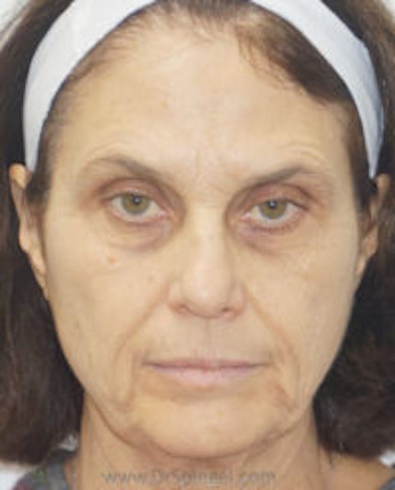 Liquid Face Lift Before & After Gallery - Patient 157140430 - Image 1