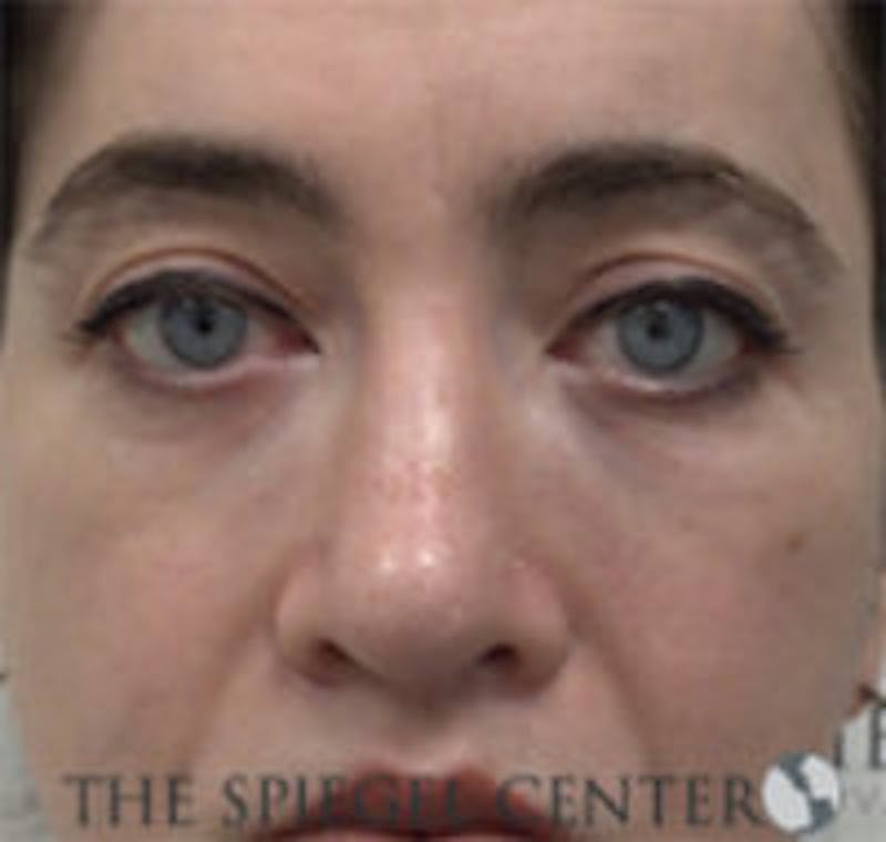 Rhinoplasty Before & After Gallery - Patient 157140434 - Image 4