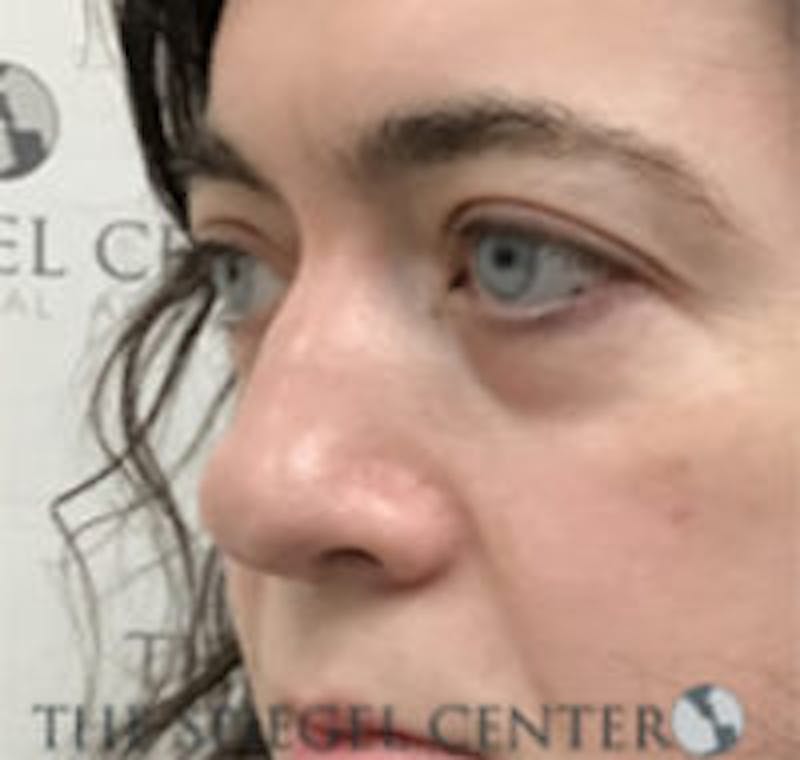 Rhinoplasty Before & After Gallery - Patient 157140434 - Image 1