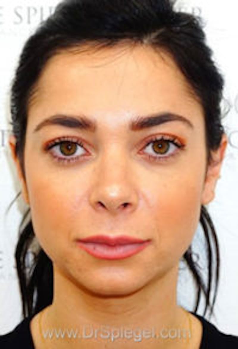 Botox / Dysport / Jeuveau / Xeomin Before & After Gallery - Patient 157140431 - Image 4