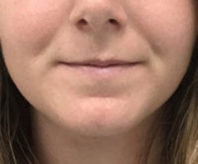 Facetite / Necktite / Embrace / Accutite Before & After Gallery - Patient 157140437 - Image 2