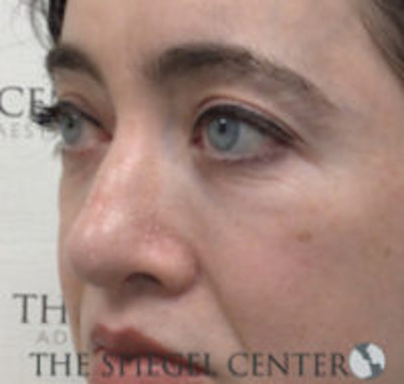 Rhinoplasty Before & After Gallery - Patient 157140434 - Image 2