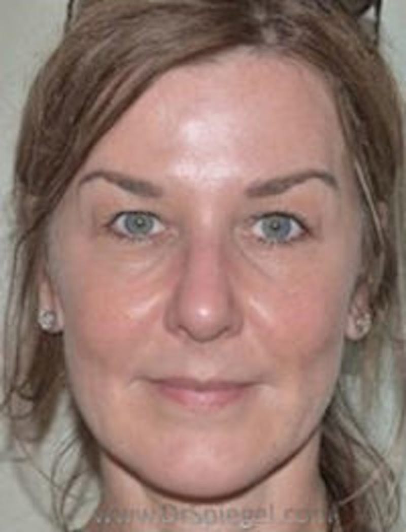 IPL / Intense Pulse Light Before & After Gallery - Patient 157140440 - Image 1