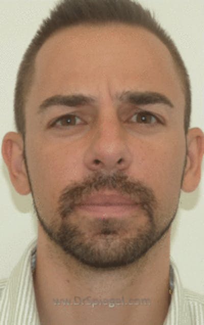 Botox / Dysport / Jeuveau / Xeomin Before & After Gallery - Patient 157140442 - Image 1