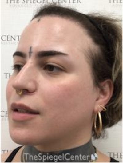 FFS Before & After Gallery - Patient 157140436 - Image 4