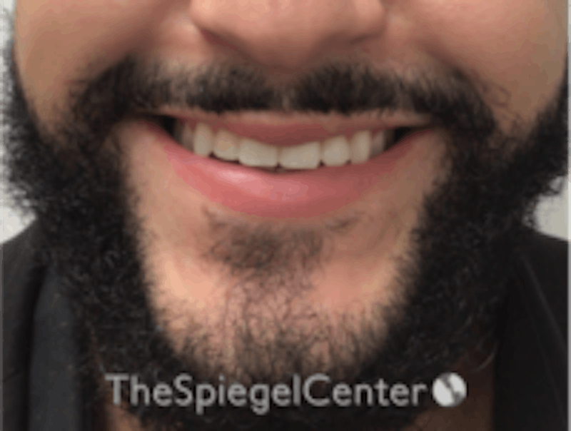 Lip Filler Before & After Gallery - Patient 157140451 - Image 1