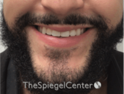 Lip Filler Before & After Gallery - Patient 157140451 - Image 1