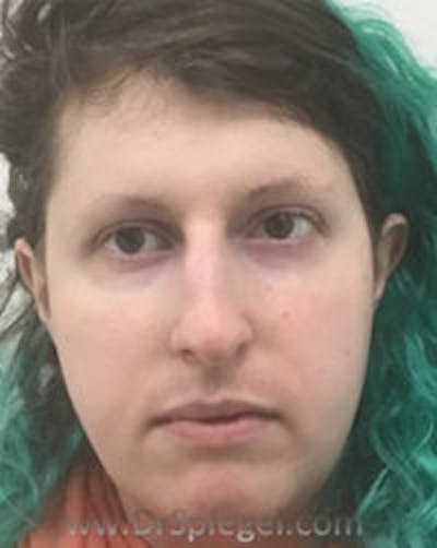 FFS Before & After Gallery - Patient 157140448 - Image 1