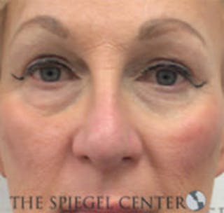 Rhinoplasty Before & After Gallery - Patient 157140447 - Image 4