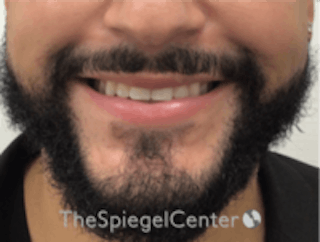 Lip Filler Before & After Gallery - Patient 157140451 - Image 2