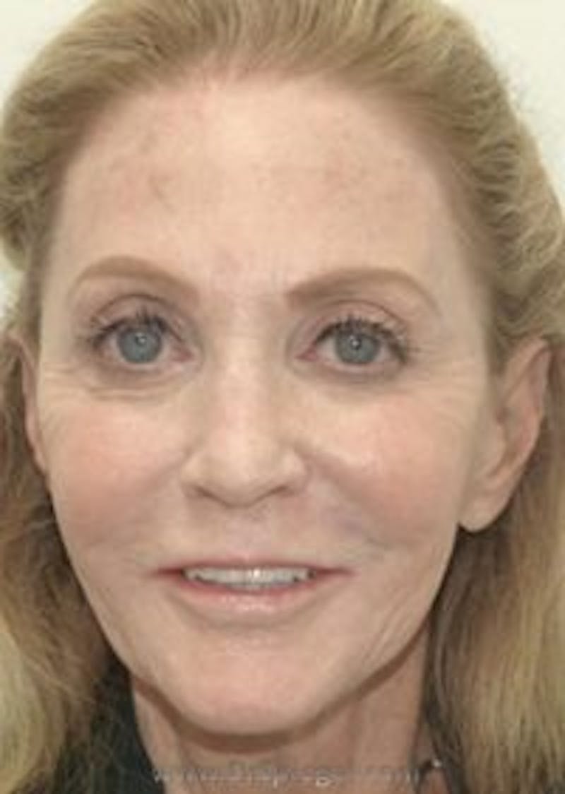 Liquid Face Lift Before & After Gallery - Patient 157140445 - Image 1