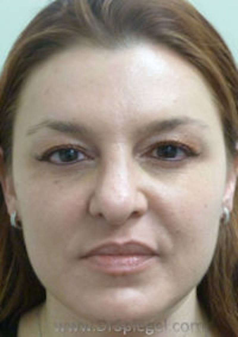 Liquid Face Lift Before & After Gallery - Patient 183935121 - Image 1