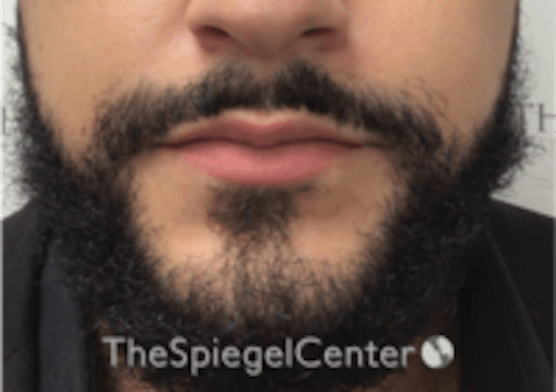 Lip Filler Before & After Gallery - Patient 157140451 - Image 3