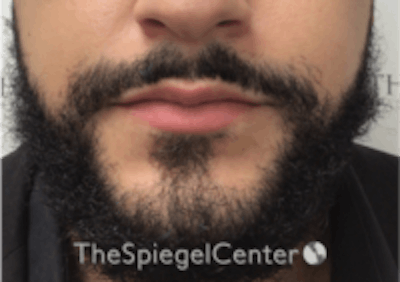 Lip Filler Before & After Gallery - Patient 157140451 - Image 3