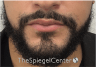 Lip Filler Before & After Gallery - Patient 157140451 - Image 4