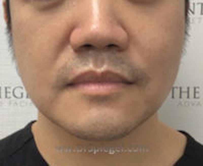 Masseter Botox Before & After Gallery - Patient 157140453 - Image 1