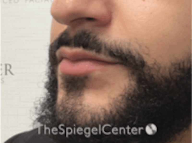 Lip Filler Before & After Gallery - Patient 157140451 - Image 5