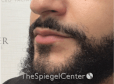Lip Filler Before & After Gallery - Patient 157140451 - Image 5