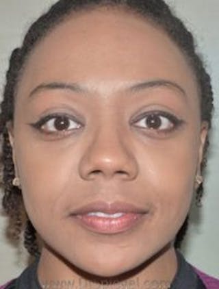 Botox / Dysport / Jeuveau / Xeomin Before & After Gallery - Patient 157140452 - Image 2