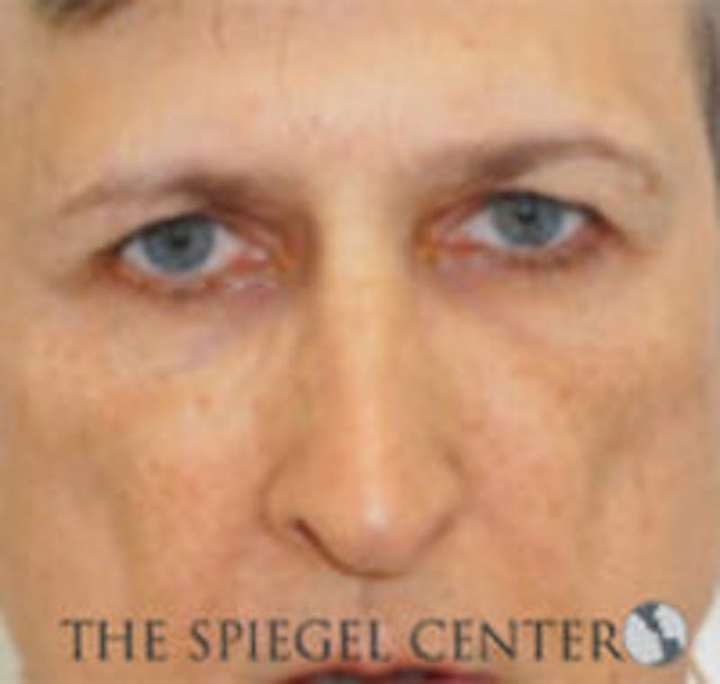 Rhinoplasty Before & After Gallery - Patient 157140455 - Image 3