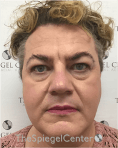 FFS Before & After Gallery - Patient 157140457 - Image 1