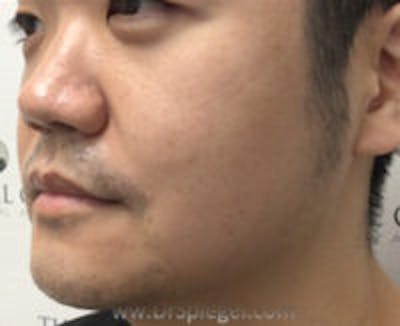 Masseter Botox Before & After Gallery - Patient 157140453 - Image 3