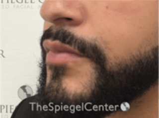 Lip Filler Before & After Gallery - Patient 157140451 - Image 6