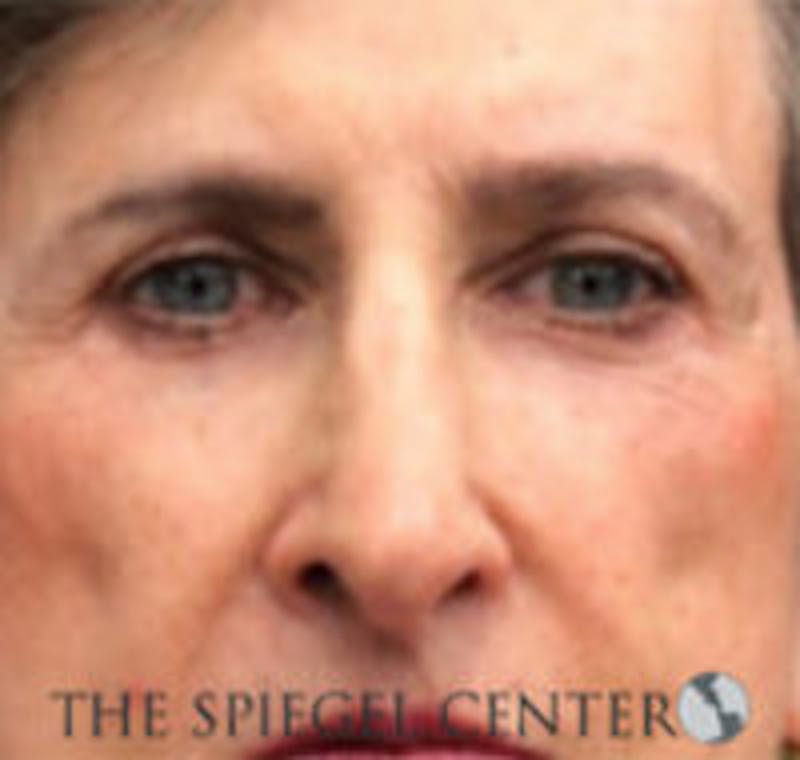 Rhinoplasty Before & After Gallery - Patient 157140455 - Image 4