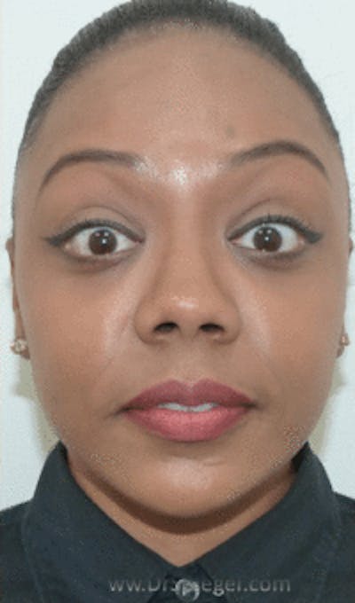 Botox / Dysport / Jeuveau / Xeomin Before & After Gallery - Patient 157140452 - Image 4