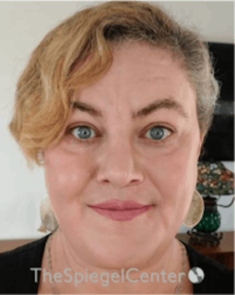 FFS Before & After Gallery - Patient 157140457 - Image 2