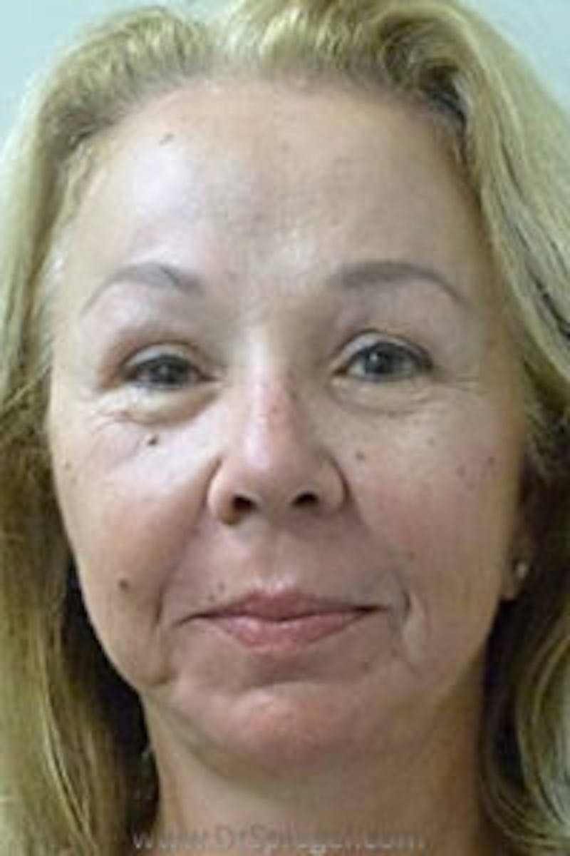 Liquid Face Lift Before & After Gallery - Patient 183935123 - Image 1