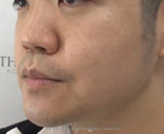 Masseter Botox Before & After Gallery - Patient 157140453 - Image 4