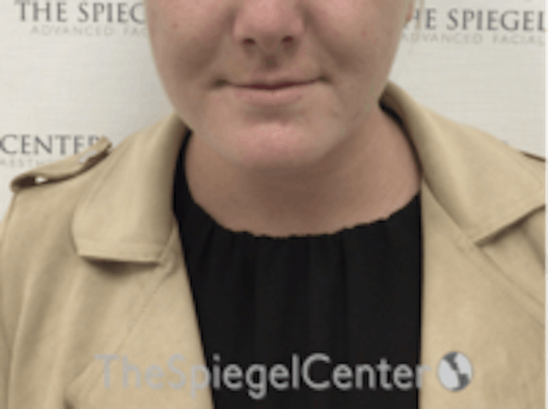 Facetite / Necktite / Embrace / Accutite Before & After Gallery - Patient 157140456 - Image 2