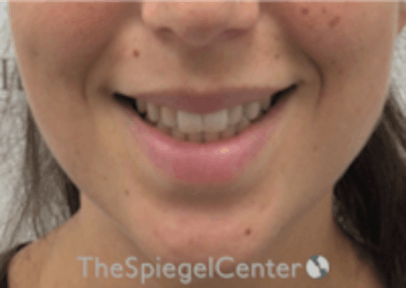 Lip Filler Before & After Gallery - Patient 157140463 - Image 1