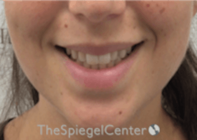 Lip Filler Before & After Gallery - Patient 157140463 - Image 1