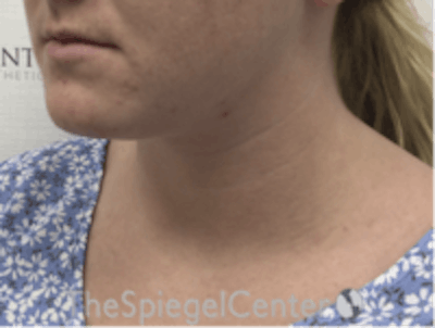 Facetite / Necktite / Embrace / Accutite Before & After Gallery - Patient 157140456 - Image 3