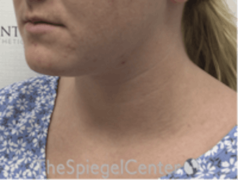 Facetite / Necktite / Embrace Before & After Gallery - Patient 157140456 - Image 3