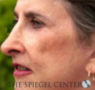 Rhinoplasty Before & After Gallery - Patient 157140455 - Image 2