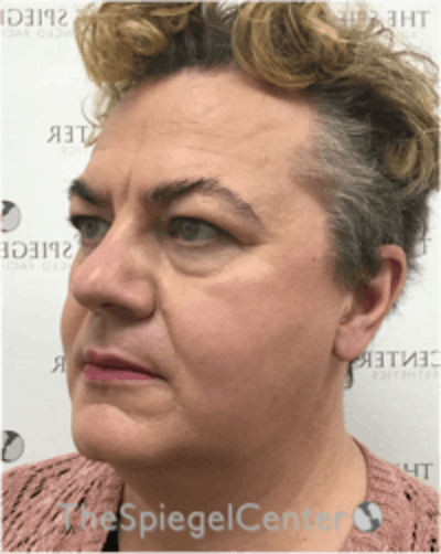 FFS Before & After Gallery - Patient 157140457 - Image 3