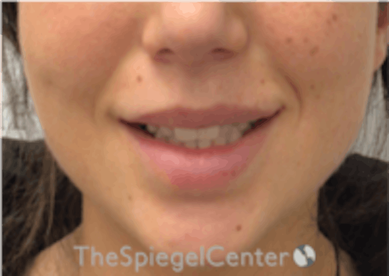 Lip Filler Before & After Gallery - Patient 157140463 - Image 2